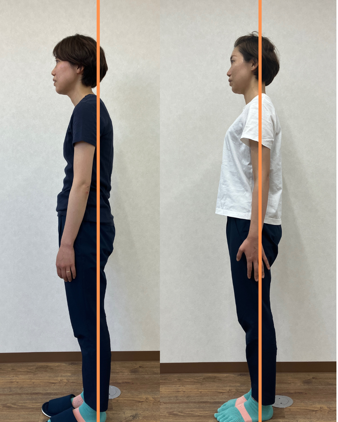 姿勢改善のビフォーアフター例2